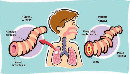 child-asthma-print-version
